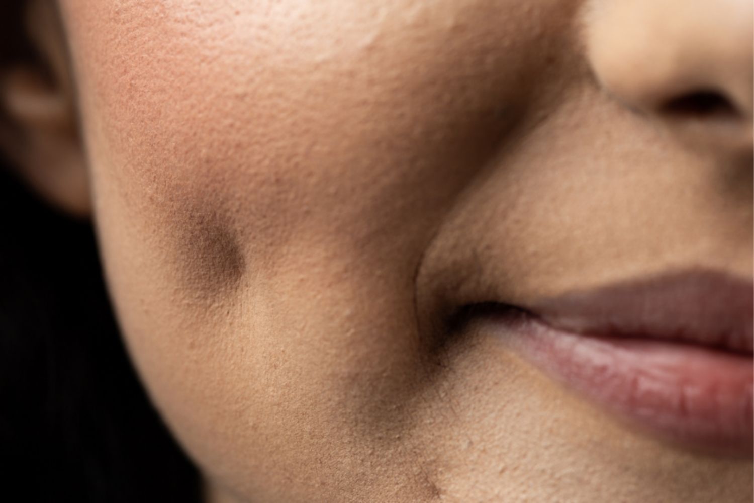 Dimple Surgery 1