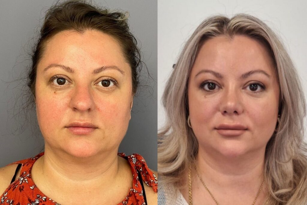Eyelid Surgery 1