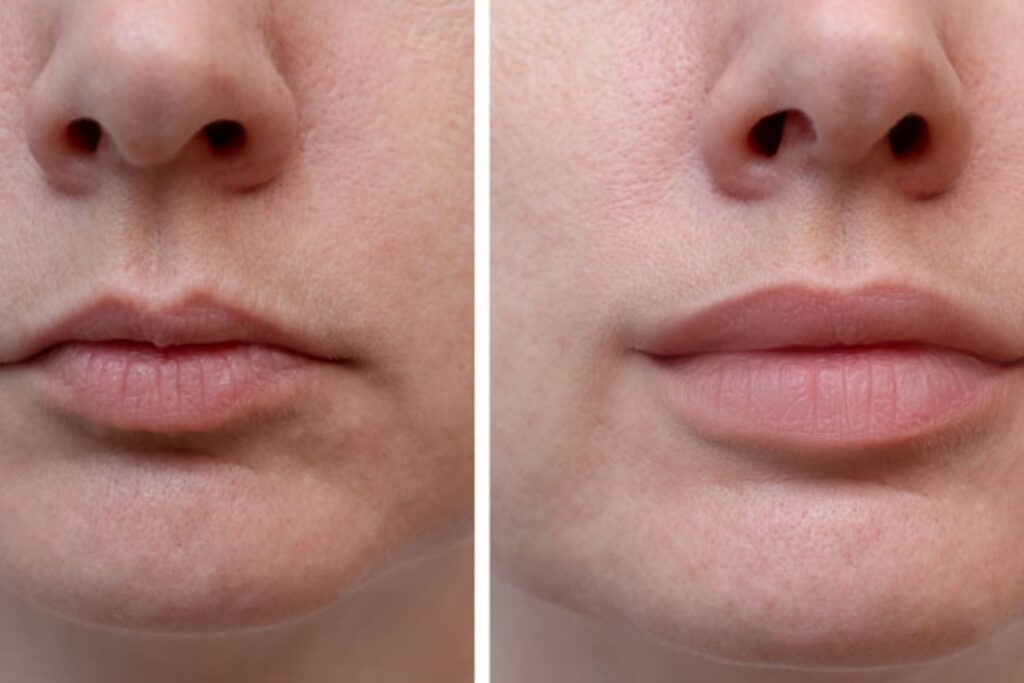 Lip Filler 4