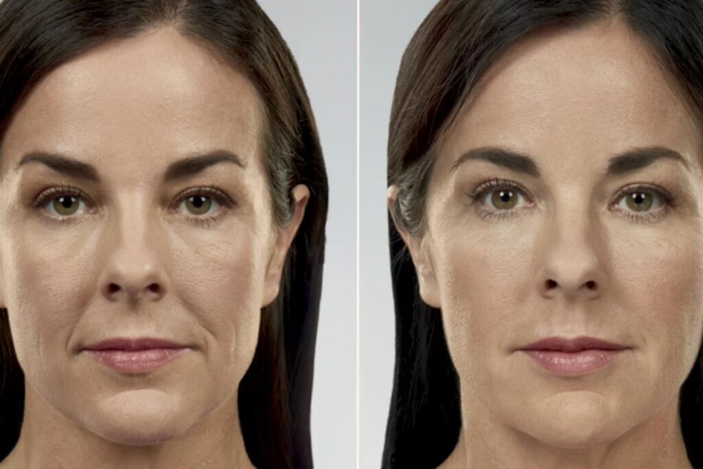 Midface Filler 4