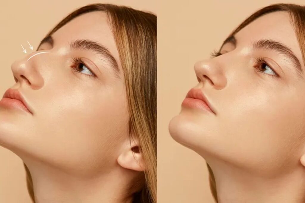 Nasal Aesthetics 5