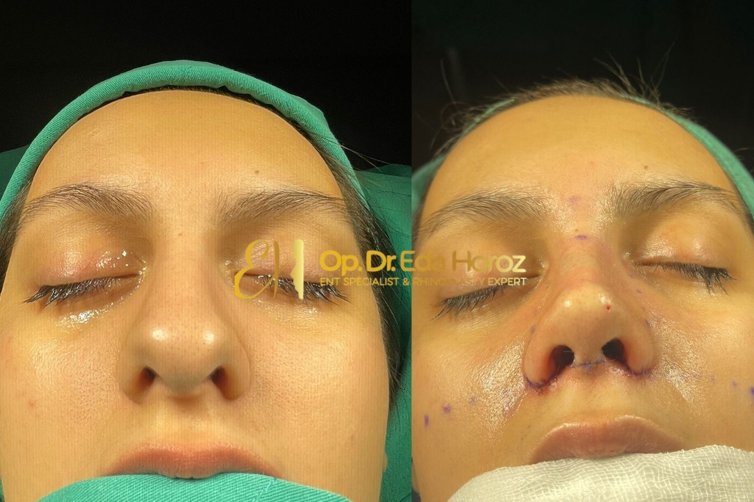 Revision Rhinoplasty 7 (1)