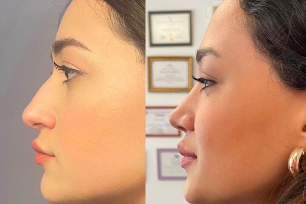 barbie nose 6